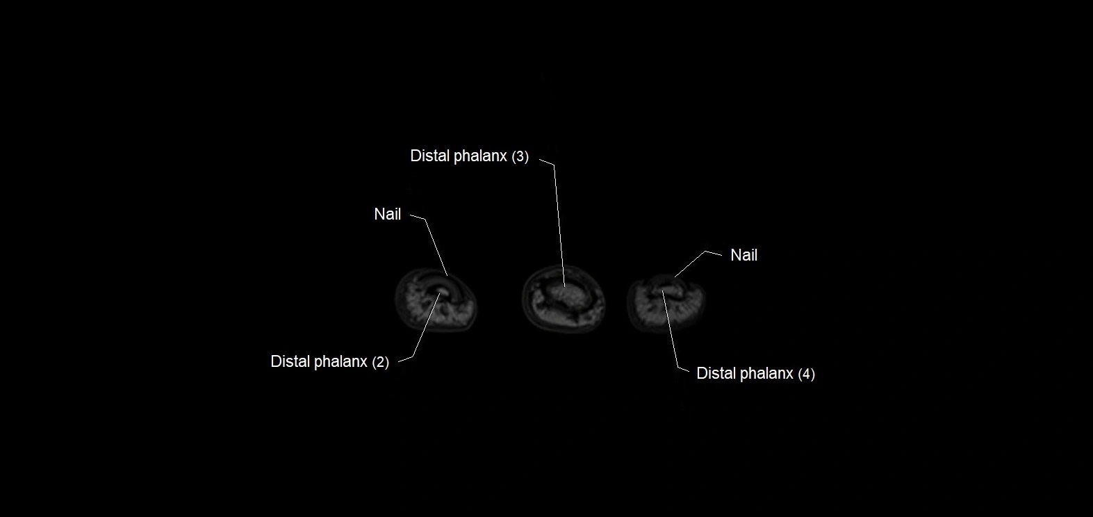 MRI 3T  hand axial labelled cross sectional anatomy imagemy  40.webp